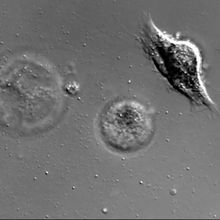 Grayscale microscopic image of dying melanoma cells