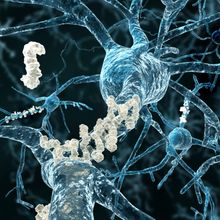 Amyloid plaques on axons of neurons