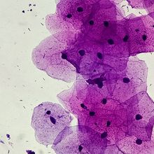 Micrograph image of cancer cells stained violet.