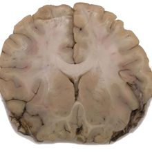 Coronal section of a brain