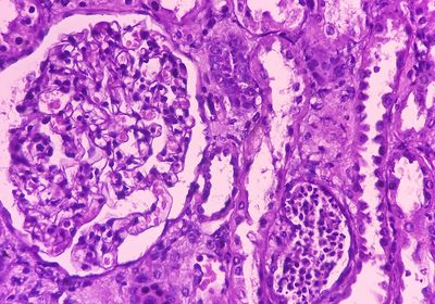 Histological image of ccRCC