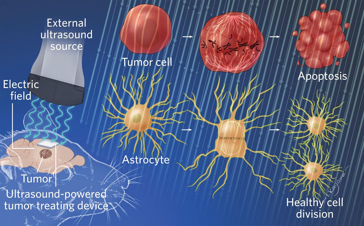 A wireless device implanted inside a rat brain shrinks cancer cells remaining after surgery. When triggered by ultrasound, the implant produces an electrical tumor-treating field (TTF) that interferes with proteins involved in cell division and triggers apoptosis in tumor cells. Healthy cells such as astrocytes, meanwhile, aren’t disrupted by the electrical frequency emitted by the device, while neurons are unaffected because they don’t divide. The researchers say that two implants would be used in humans, sandwiching the tumor.