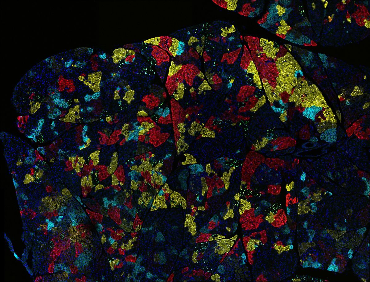 A colorful microscope picture of a mosaic tumor