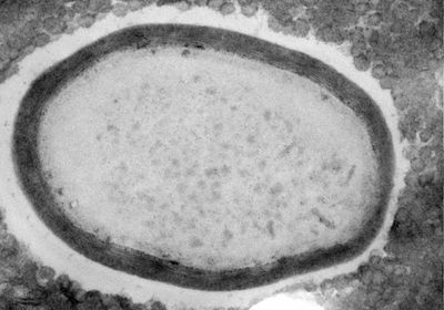 The giant virus <em >Pandoravirus neocaledonia&nbsp;</em>inside the amoeba <em>Acanthamoeba castellanii</em>.