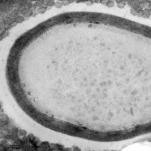 The giant virus <em >Pandoravirus neocaledonia&nbsp;</em>inside the amoeba <em>Acanthamoeba castellanii</em>.