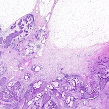 A purple-stained section of an invasive breast cancer growth. The dark purple non-fatty tissue takes up the majority of the frame, and pale purple circular tumors grow in ducts in the bottom left.
