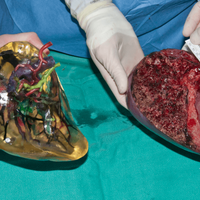 3d printed organ artificial liver lobe surgery