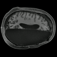 hemispherectomy epilepsy fmri brain neural connections