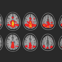 Non-Concussive Head Hits Influence the Brain&rsquo;s Microstructure